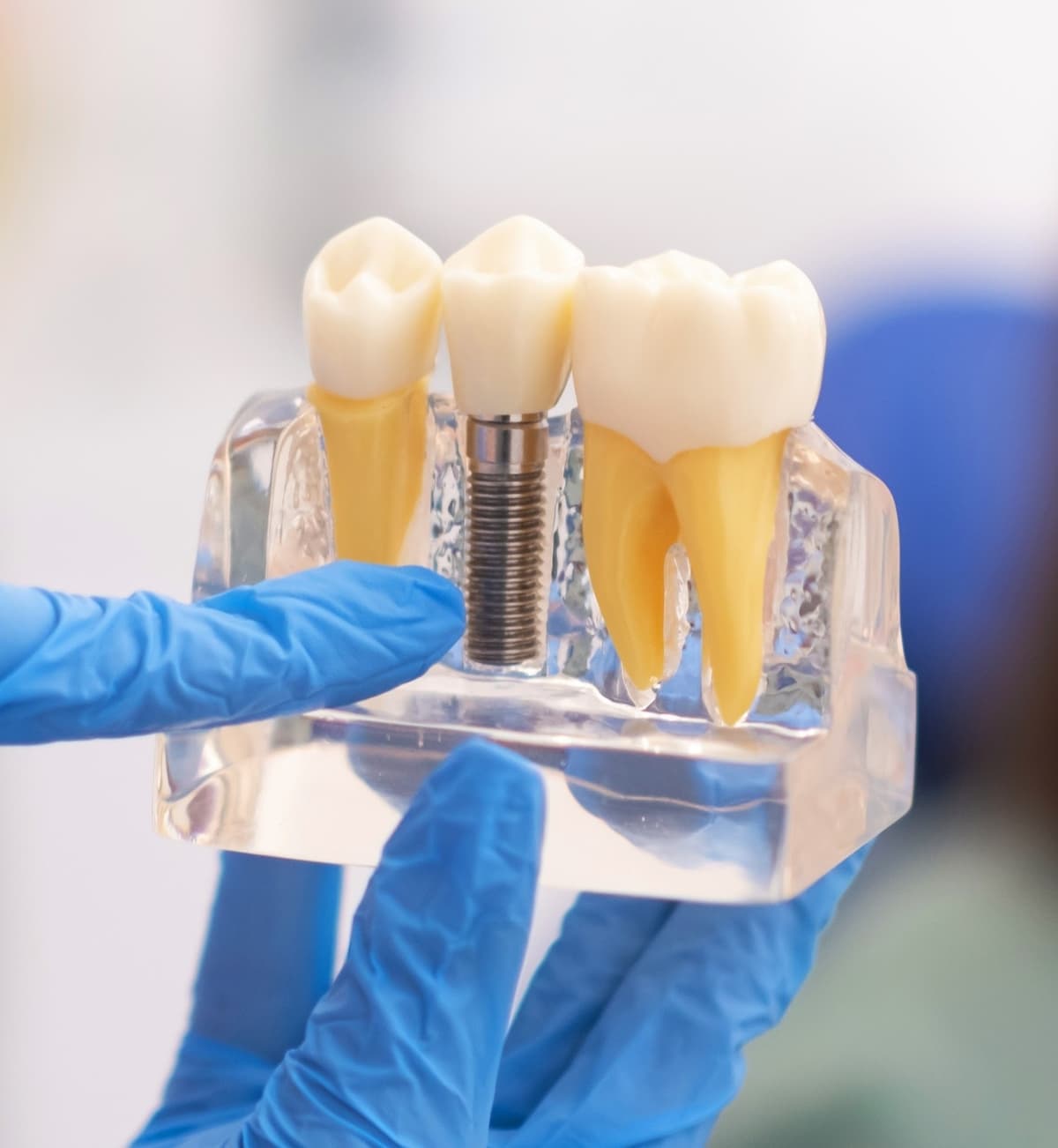 Dental Implants