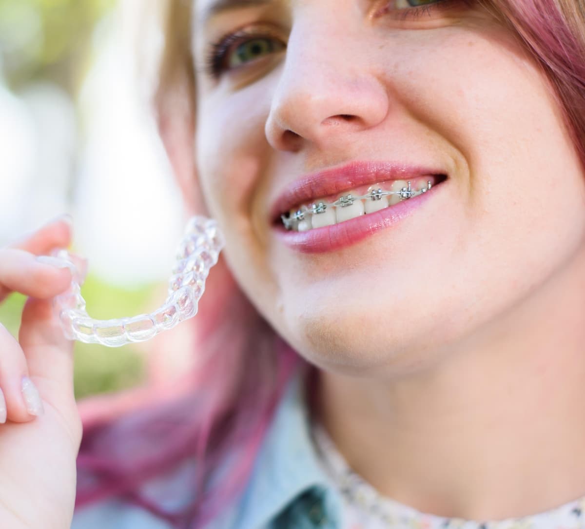 Invisible Aligners